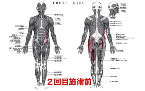 慢性腰痛で前かがみが痛い-治し方2