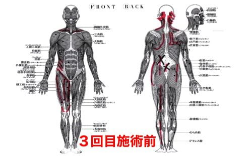 慢性腰痛で前かがみが痛い-治し方3