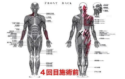 慢性腰痛で前かがみが痛い-治し方4