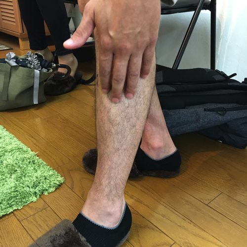 ブロック注射も効かない椎間板ヘルニアの腰の痛みと足の痺れを治すには6