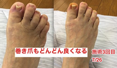 ヘルニアの治療と再発防止は足の指の曲がりを治す事も大切7