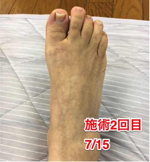 ヘルニアの治療と再発防止は足の指の曲がりを治す事も大切5