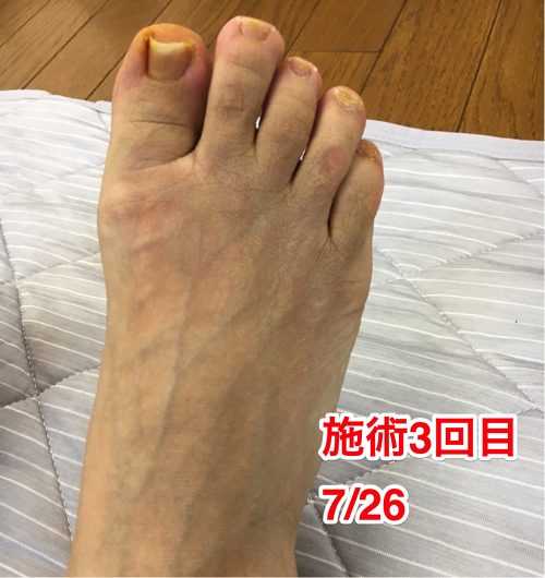 ヘルニアの治療と再発防止は足の指の曲がりを治す事も大切6-1