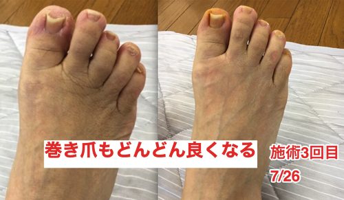 ヘルニアの治療と再発防止は足の指の曲がりを治す事も大切7