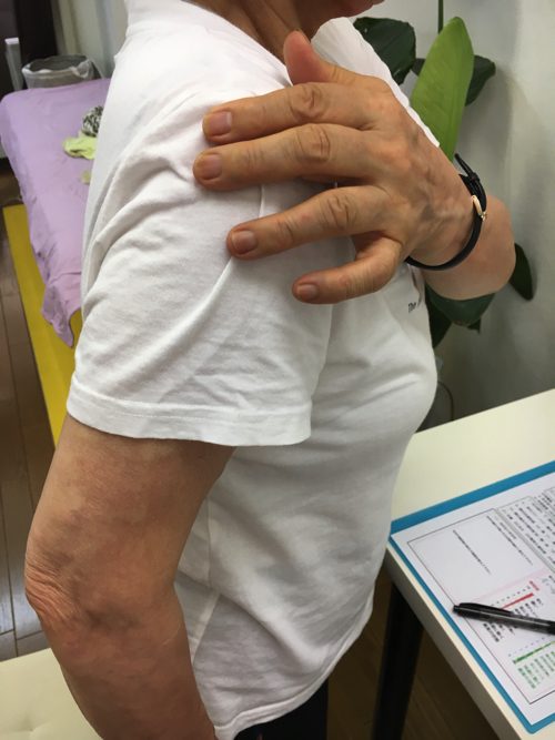 五十肩-腕を上げる際に肩が痛い-治し方4