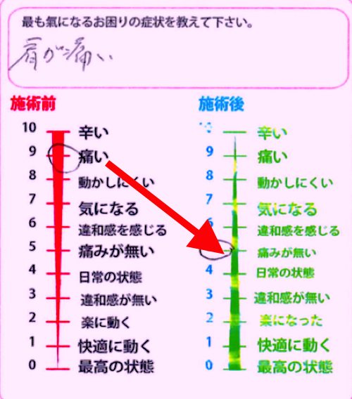 五十肩-腕を上げる際に肩が痛い-治療法1