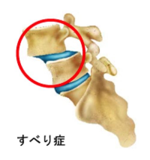 1すべり症-腰の痛みと足のシビレの治療法1