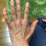 ばね指の原因と治療方法a1