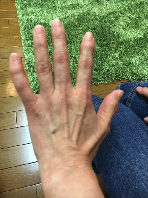 ばね指の原因と治療方法a1