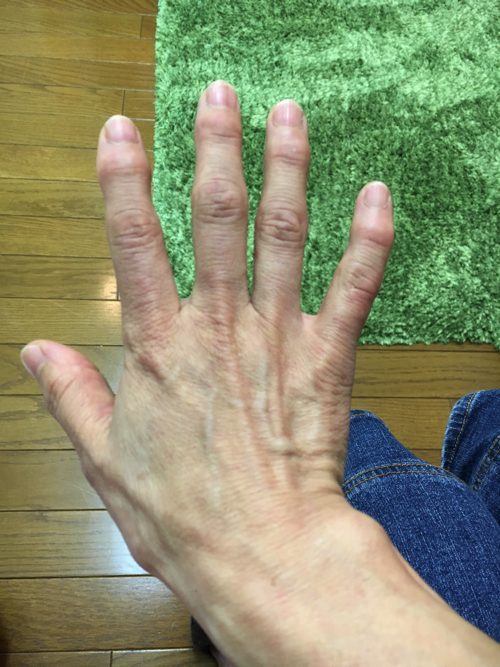 ばね指の原因と治療方法a2