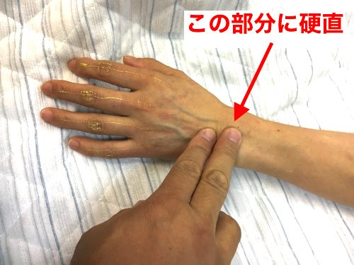 ばね指の原因と治療方法a3-1