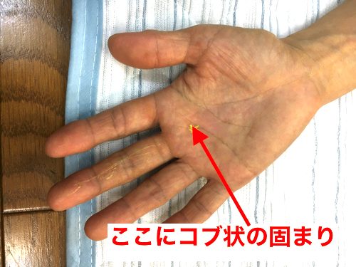 ばね 指 の 治し 方 の 治し 指 方 ばね