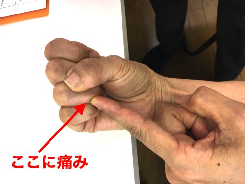 ばね指の原因と治療方法b1