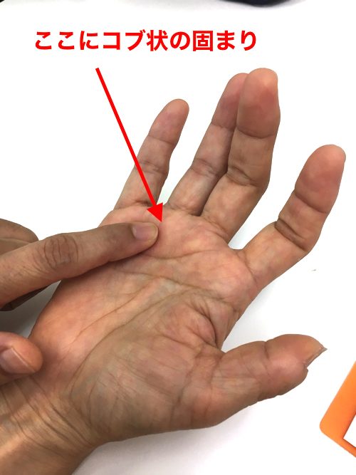 ばね指の原因と治療方法b2