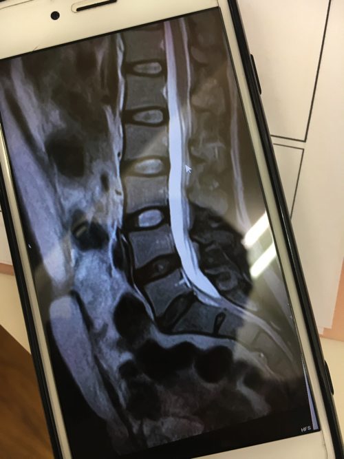 腰痛-椎間板ヘルニアの治療方法-広島で有名-腰痛専門整体院5