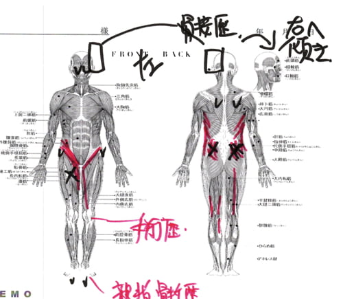 ヘルニアと側弯症で腰が痛く身体が傾く原因と治療方法