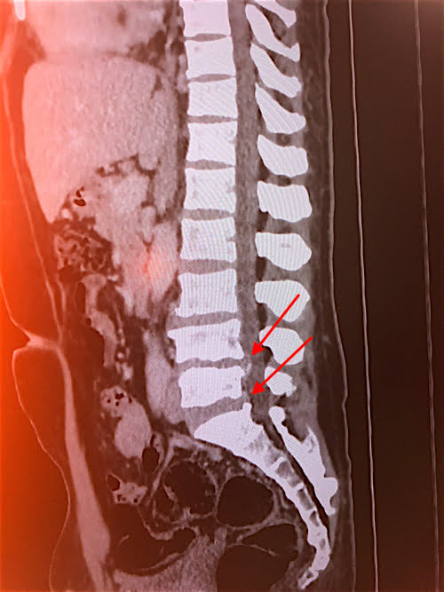 脊柱管狭窄症の原因と治療方法_広島の腰痛専門士の治った例