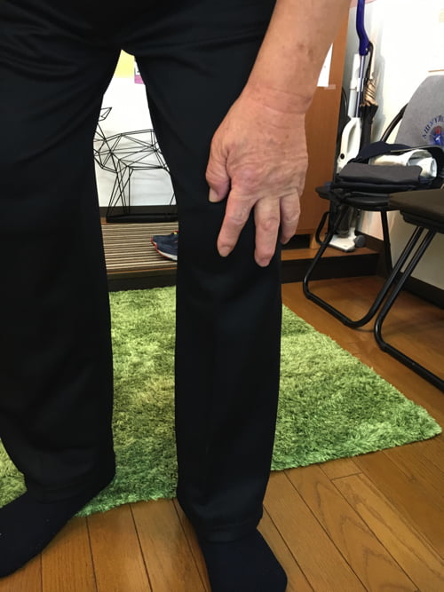 ヘルニアと診断され神経ブロックもリハビリも効果なかったが整体で治った例_広島