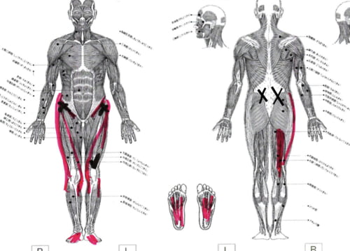 ヘルニアと診断され神経ブロックもリハビリも効果なかったが整体で治った例_広島