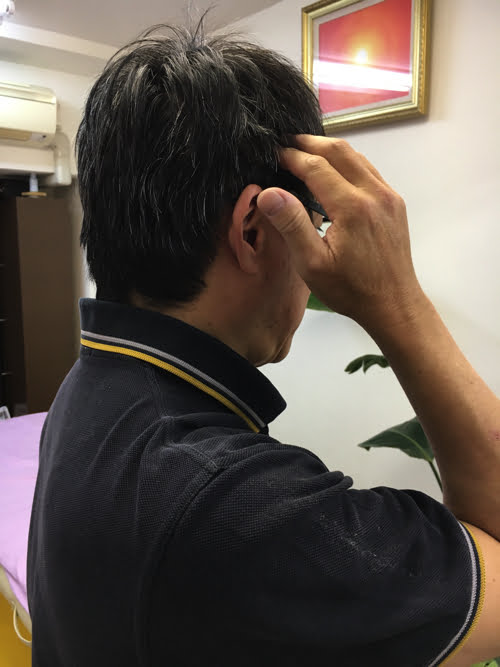 広島で偏頭痛の治療_肩から首と頭が痛い_薬を使わず治すヘッドマッサージ_ドライヘッドスパ