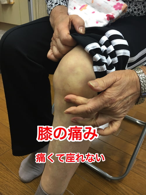 広島-膝の痛みを治す_変形性膝関節症の治療改善例