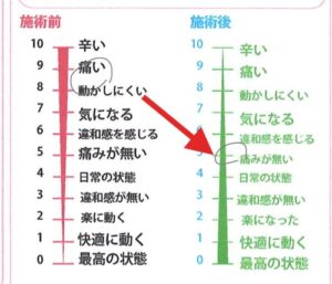 施術前後の痛みの比較レベル9からレベル5へ