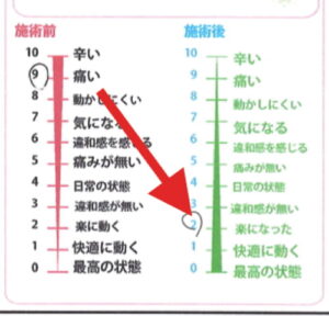 施術前後の痛みの比較レベル9からレベル2へ