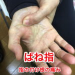 ばね指の原因と治療方法_ばね指の治し方解説_整体広島眞田流の改善例1