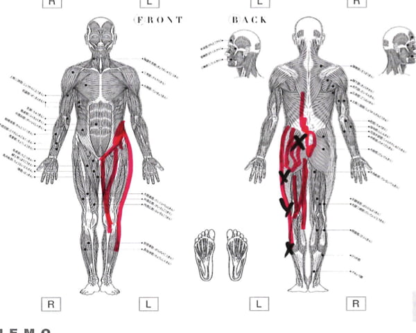 歩くと痛みが増す腰部脊柱管狭窄症と間欠性跛行の原因と治療方法の実例11