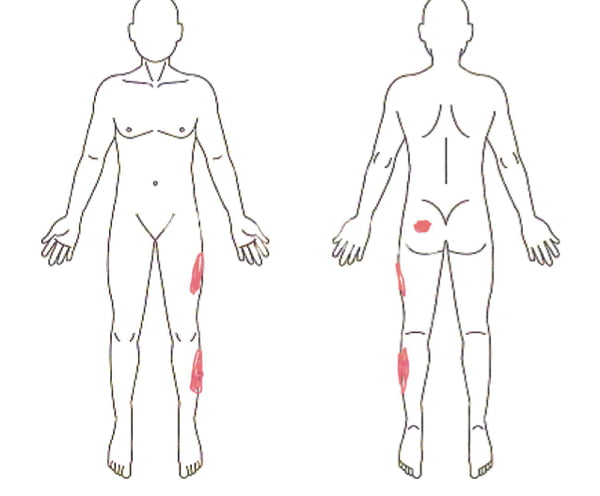 歩くと痛みが増す腰部脊柱管狭窄症と間欠性跛行の原因と治療方法の実例2