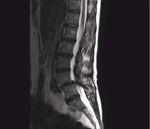 すべり症-坐骨神経痛の治療で痛みが消えた実例1すべり症-坐骨神経痛の治療で痛みが消えた実例1