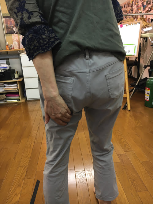 腰痛-すべり症-坐骨神経痛の治療で痛みが消えた実例6