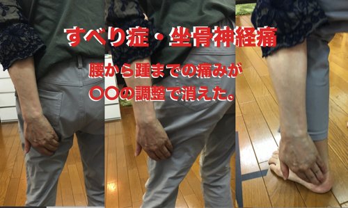 腰痛-すべり症-坐骨神経痛の治療で痛みが消えた実例8