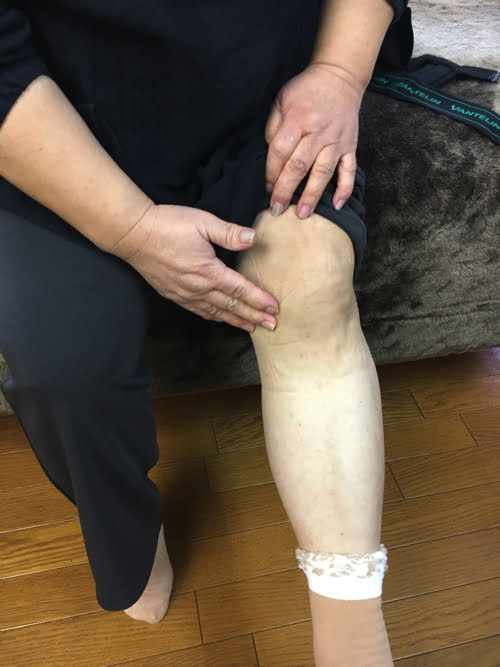 歩くと膝が痛い変形性膝関節症と膝の水たまり治療1