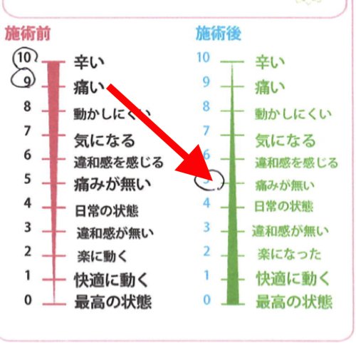 歩くと膝が痛い変形性膝関節症と膝の水たまり治療9