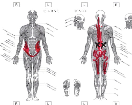 AKA博田法効果なし-慢性腰痛-長く続くぎっくり腰-原因と治療方法6