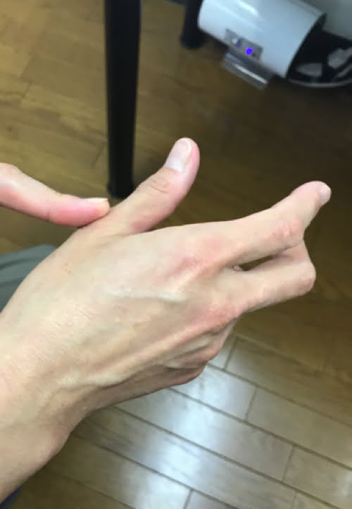 頚椎ヘルニアで指の痺れ原因と治療方法1