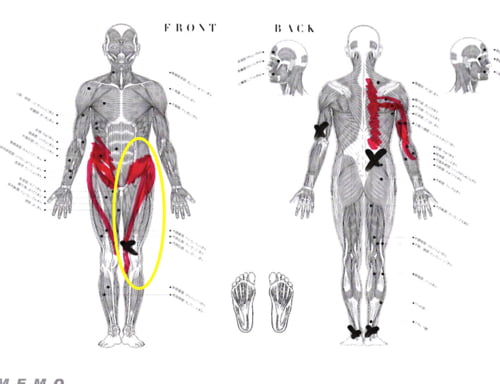 脊椎分離すべり症の腰の痛みの原因と治療方法16