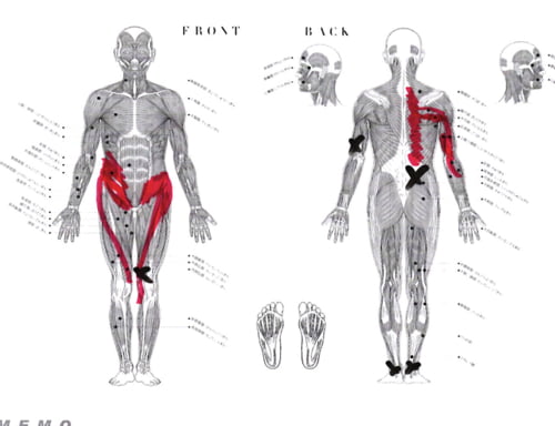 脊椎分離すべり症の腰の痛みの原因と治療方法8