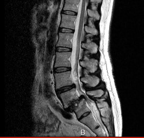 脊椎分離すべり症の腰の痛みの原因と治療方法9