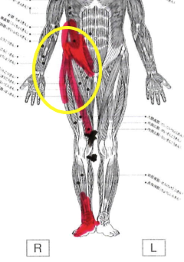 膝の痛みの治療_ヒアルロン酸注射が効かない場合の原因と治療法9