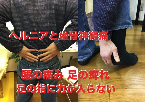 ヘルニア 坐骨神経痛で100万円以上かかったが治らずご来院 腰の痛み 足のシビレ 足の指に力が入らない症状の原因と治療方法 整体広島眞田流