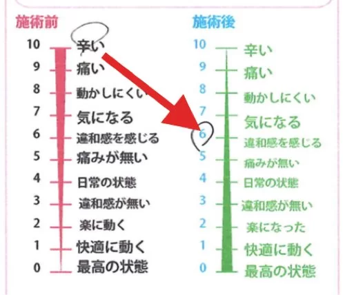ぎっくり腰_ヘルニアが再発する理由と治療方法
