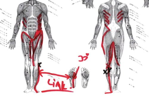 ヘルニアは誤診か-ヘルニア手術失敗か-ヘルニア手術で歩けなくなった女性の回復施術12