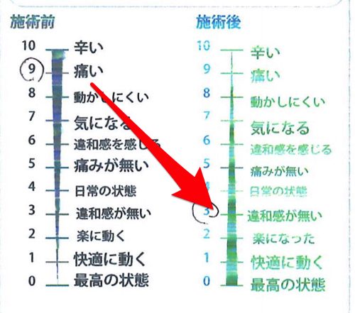 ヘルニアは誤診か-ヘルニア手術失敗か-ヘルニア手術で歩けなくなった女性の回復施術3