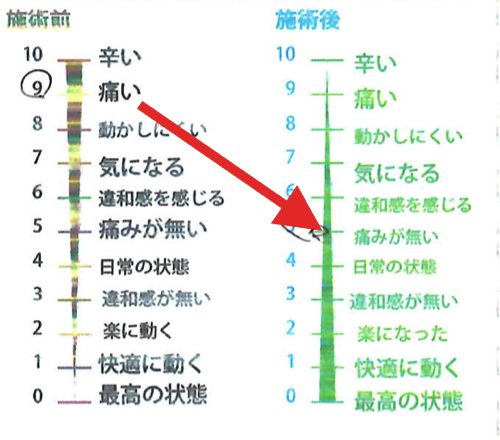 一年近く治らなかった椎間板ヘルニアの治療-広島で椎間板ヘルニアの治療なら整体広島眞田流-治った例3