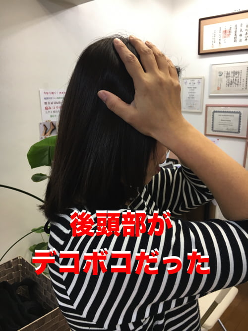 後頭部がデコボコで頭痛がする