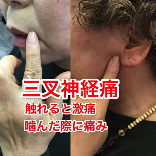 広島-整体院_三叉神経痛や顔面神経痛を手術せずにマッサージで治療
