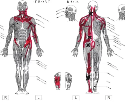 広島でヘルニア治療で有名な整体院が原因と治し方を解説