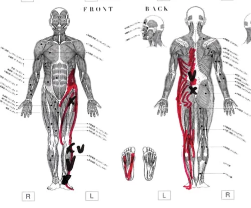 広島でヘルニア治療の有名整体院が解説-ヘルニア誤診例